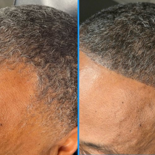 Scalp micropigmentation before and after, Houston TX