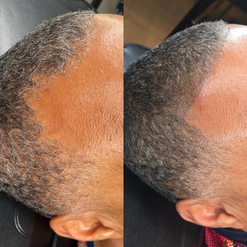Scalp pigmentation before and after on thinning hair