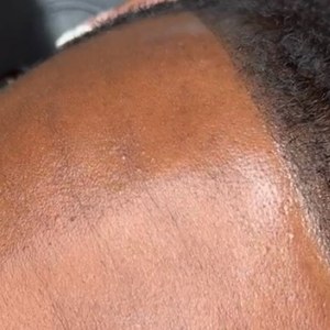 Rebuilt hairline after scalp pigmentation
