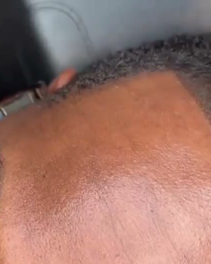 Scalp micropigmentation and scar camouflage in Houston