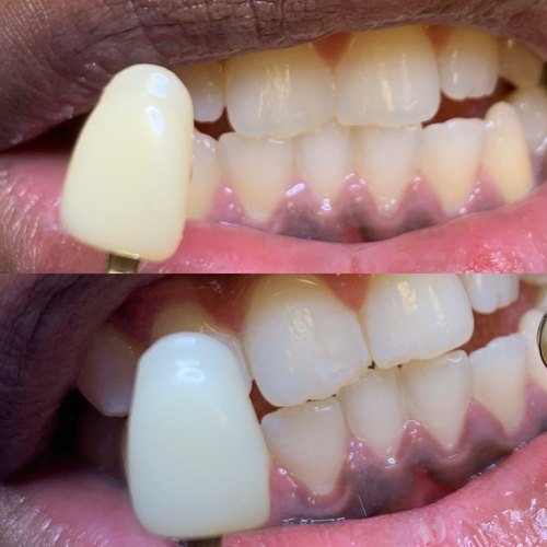 Teeth whitening before and after in Houston, TX
