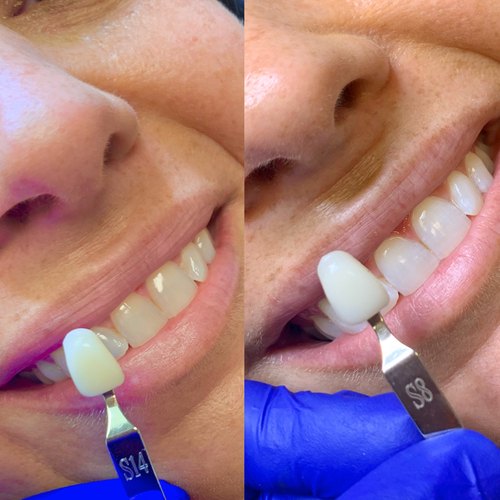 Teeth whitening shade guide comparison