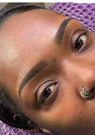 Healed brows, side view